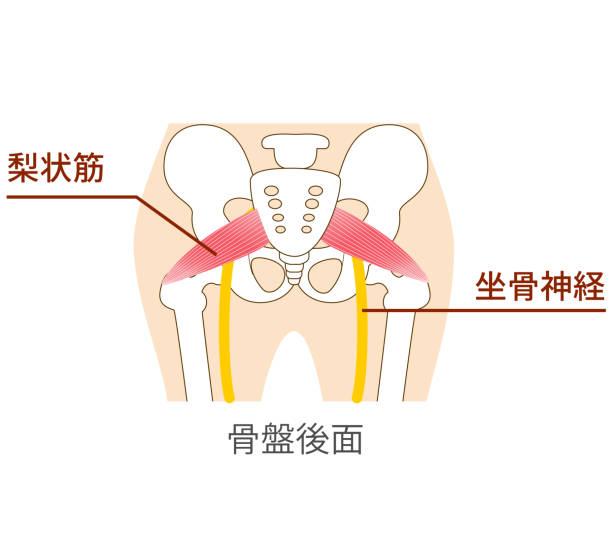 臀部痠痛到小腿？您可能是梨狀肌症候群又被稱為 假性坐骨神經痛｜台中徒手物理治療