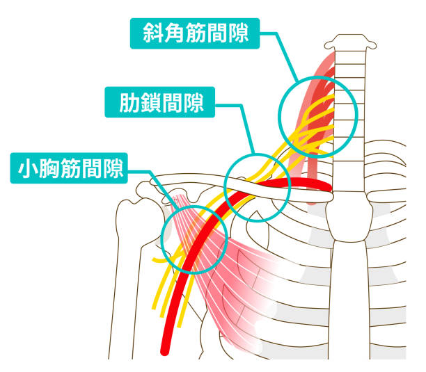 你是否經常感到手麻、肩膀或頸部痠痛，甚至有時手臂和手指感覺不靈活？這些不適可能是「胸廓出口症候群」的徵兆｜台中徒手物理治療｜南屯物理治療所