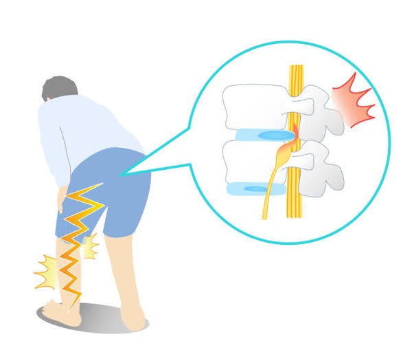 閃到腰有可能是「椎間盤突出」而不是「肌肉拉傷」｜台中物理治療所｜徒手物理治療